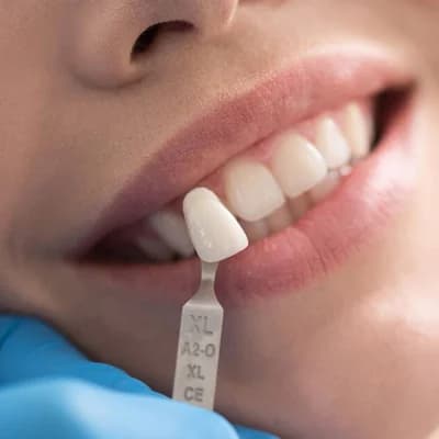 Veneers: Transform Your Smile with Precision